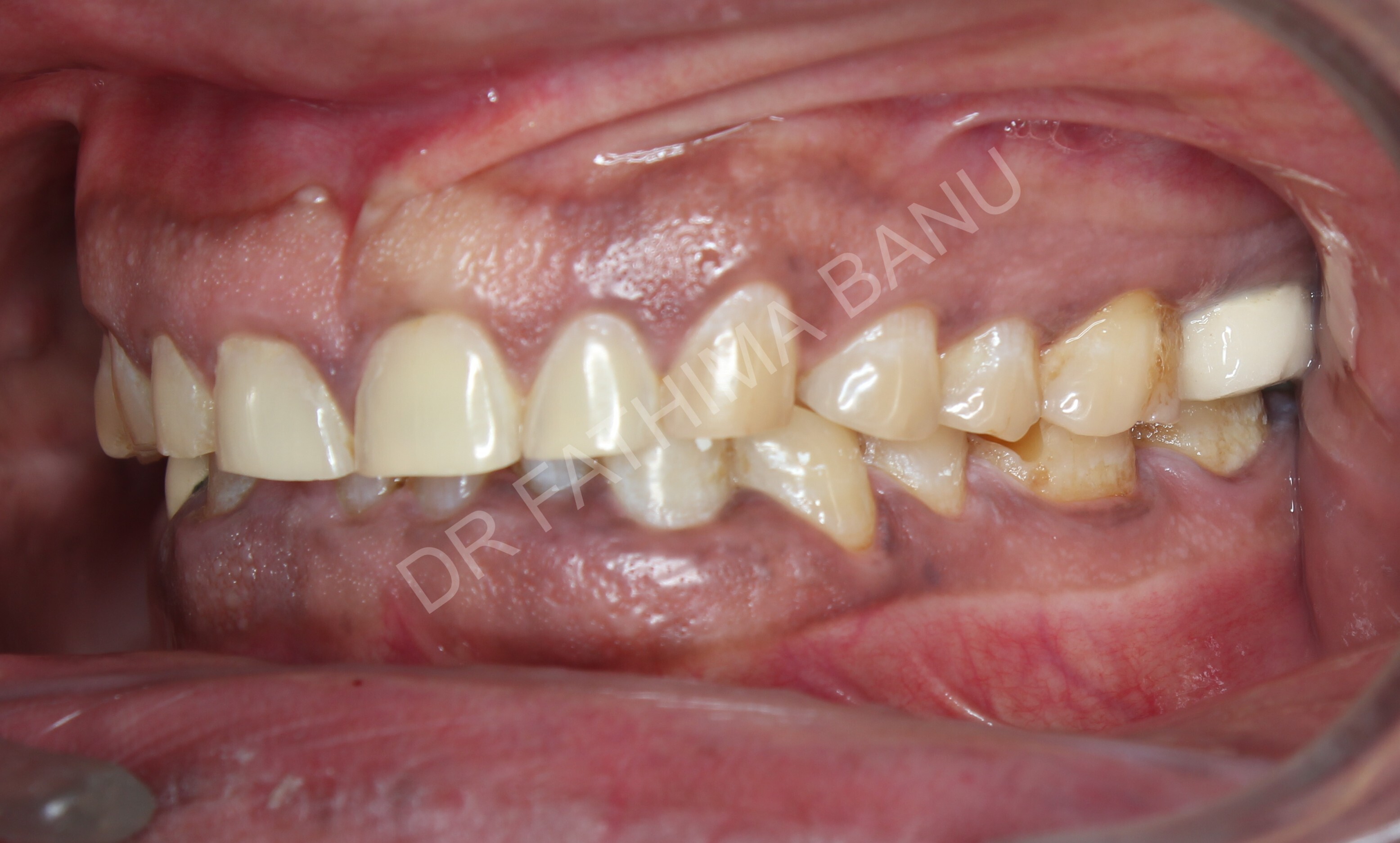 Full mouth rehabilitation Before