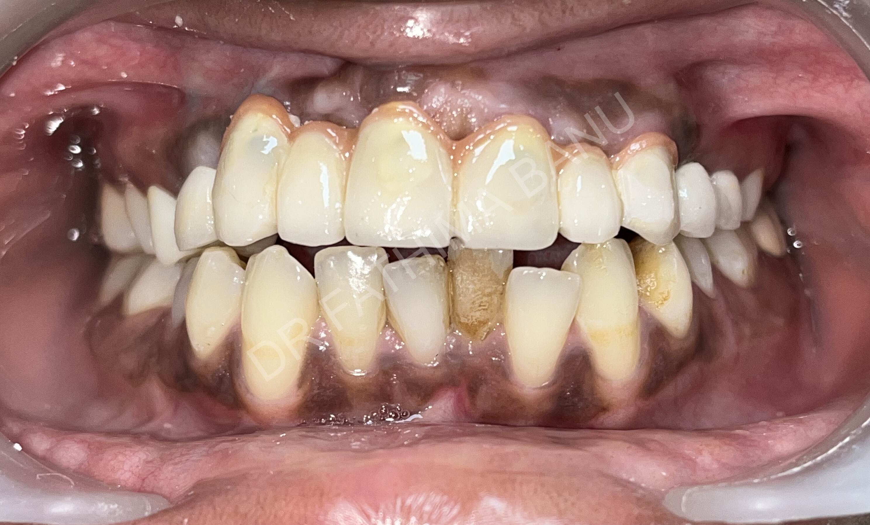 Implant supported fixed ceramic prosthesis After