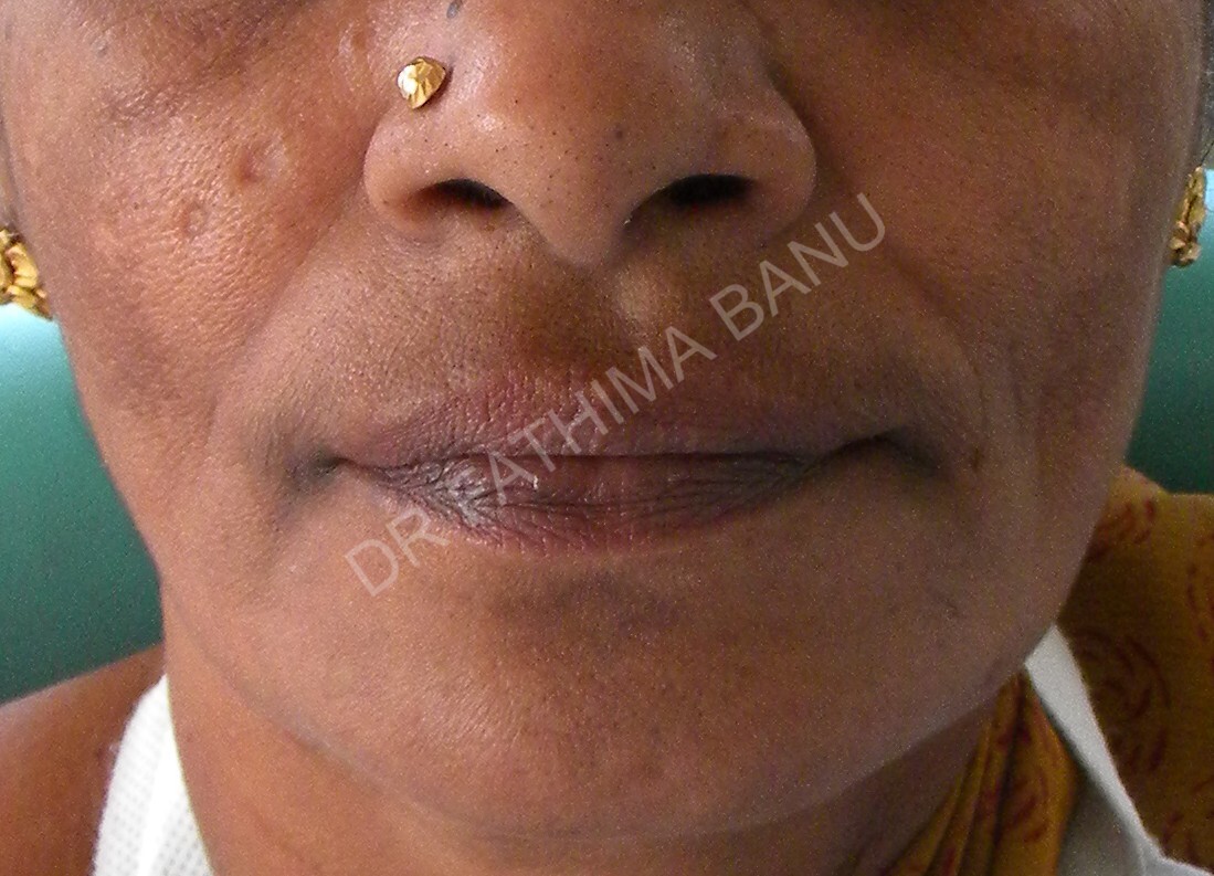 Over-denture Before