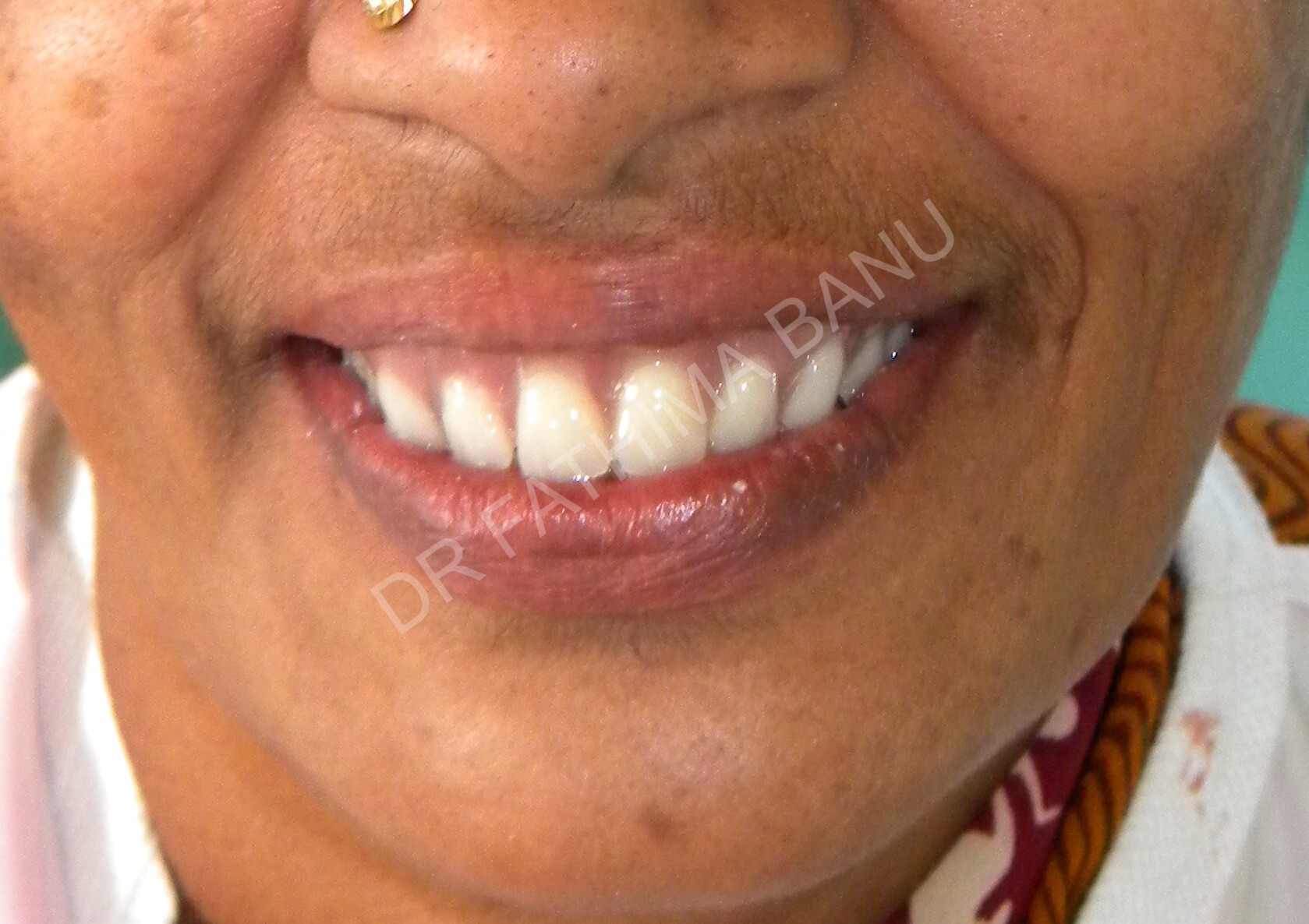 Over-denture After