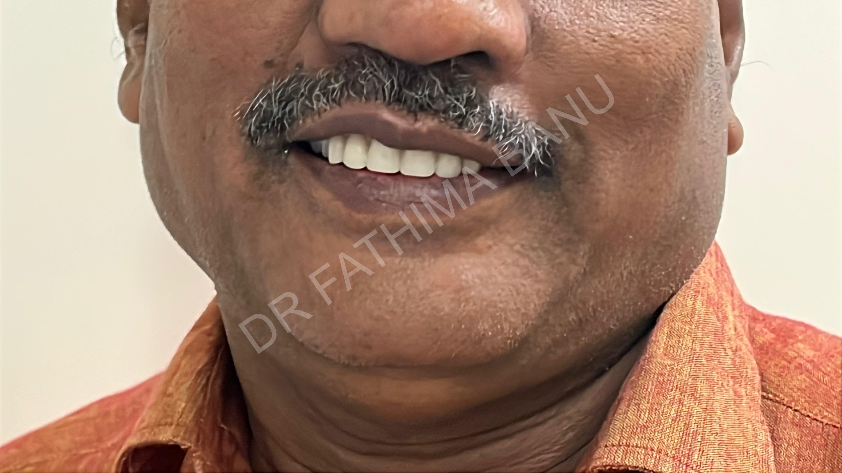 Smile designing After