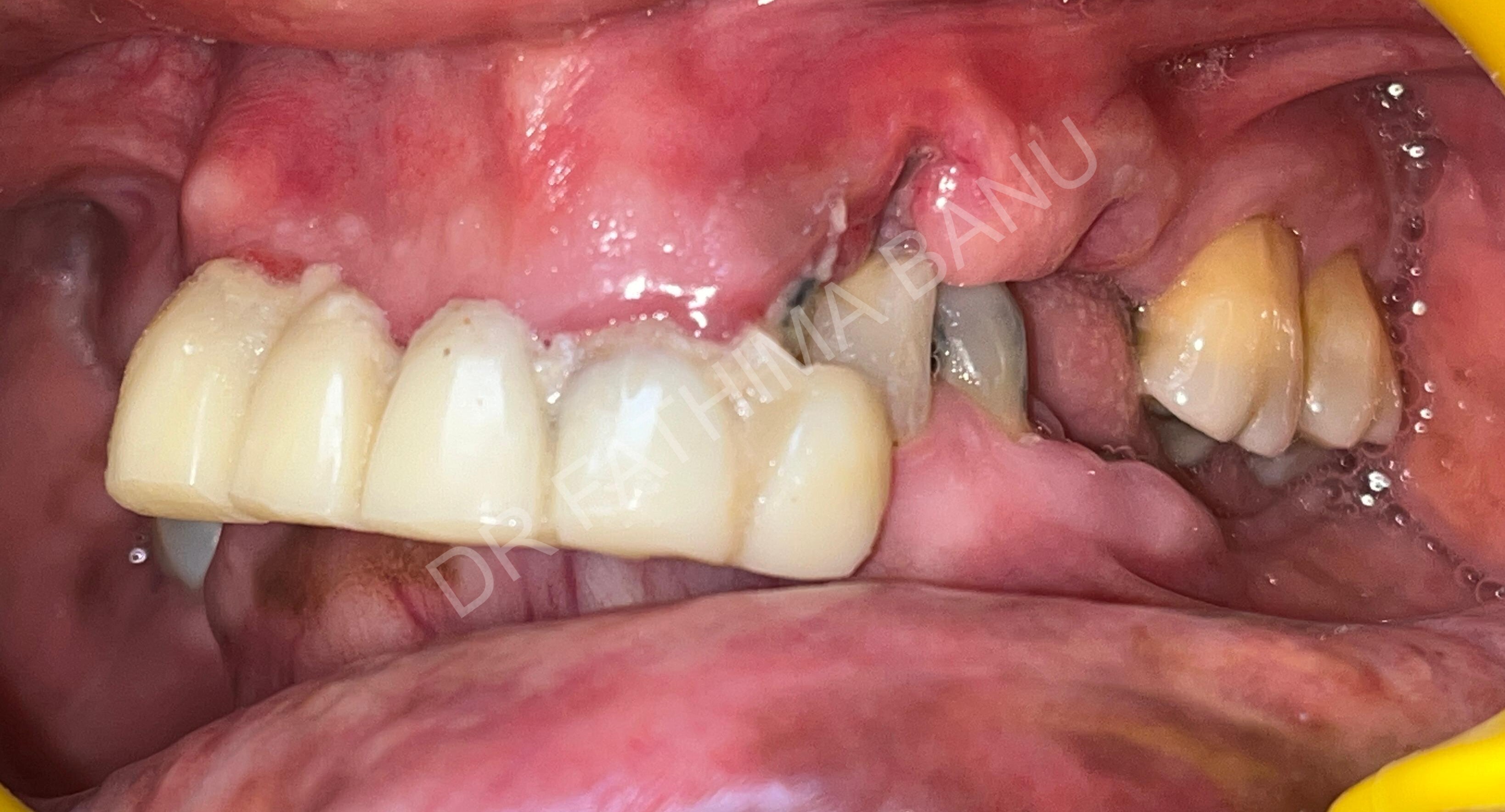 Full mouth rehabilitation of collapsed bite Before