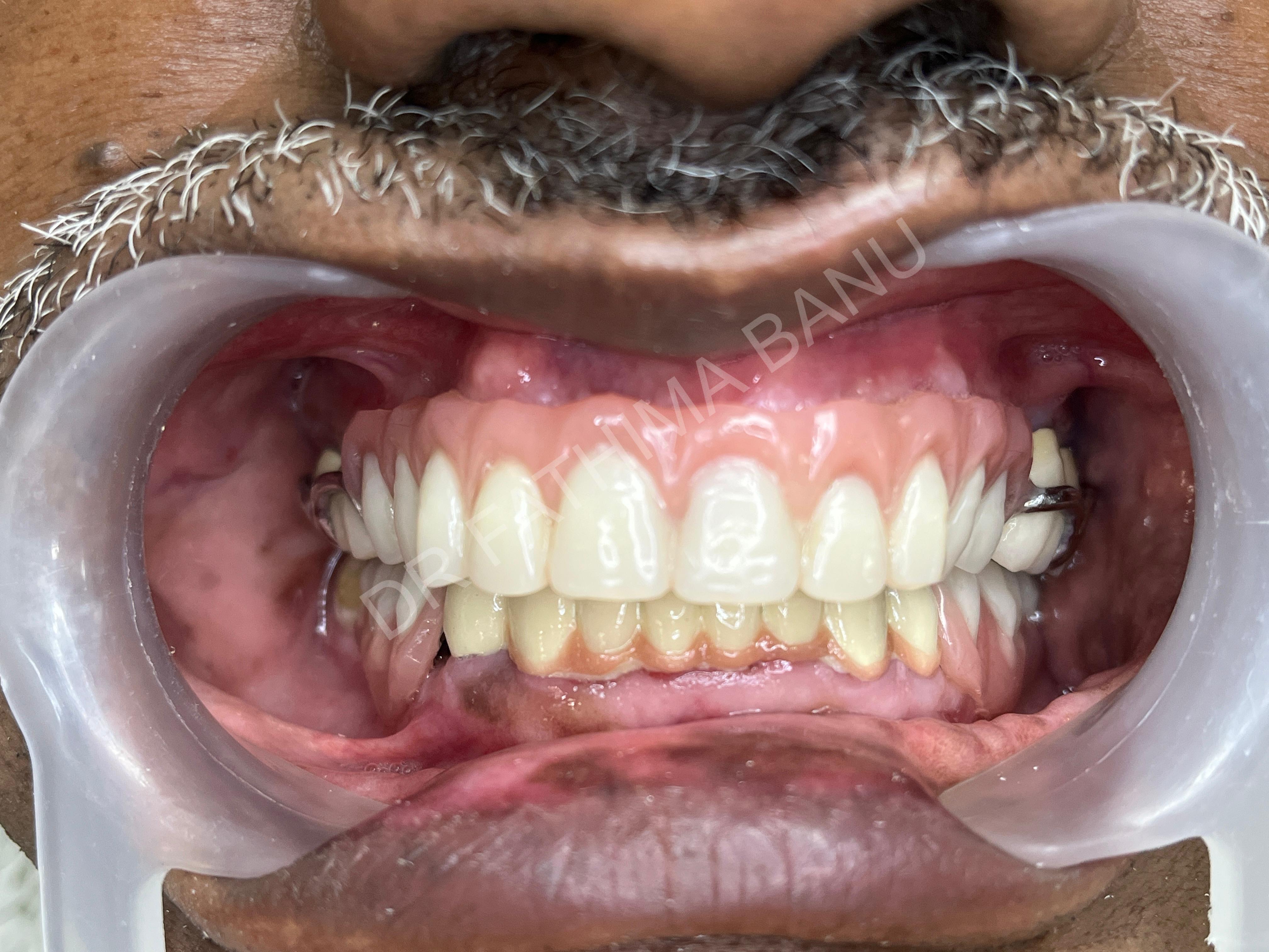 Full mouth rehabilitation of collapsed bite After