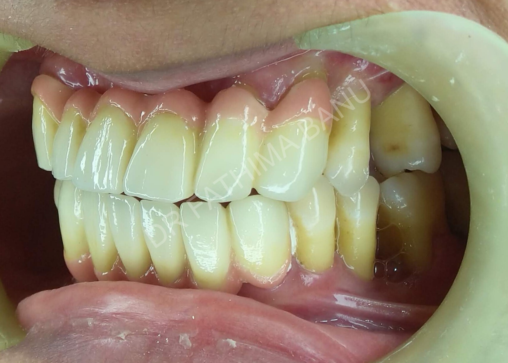 Zirconia prosthesis After