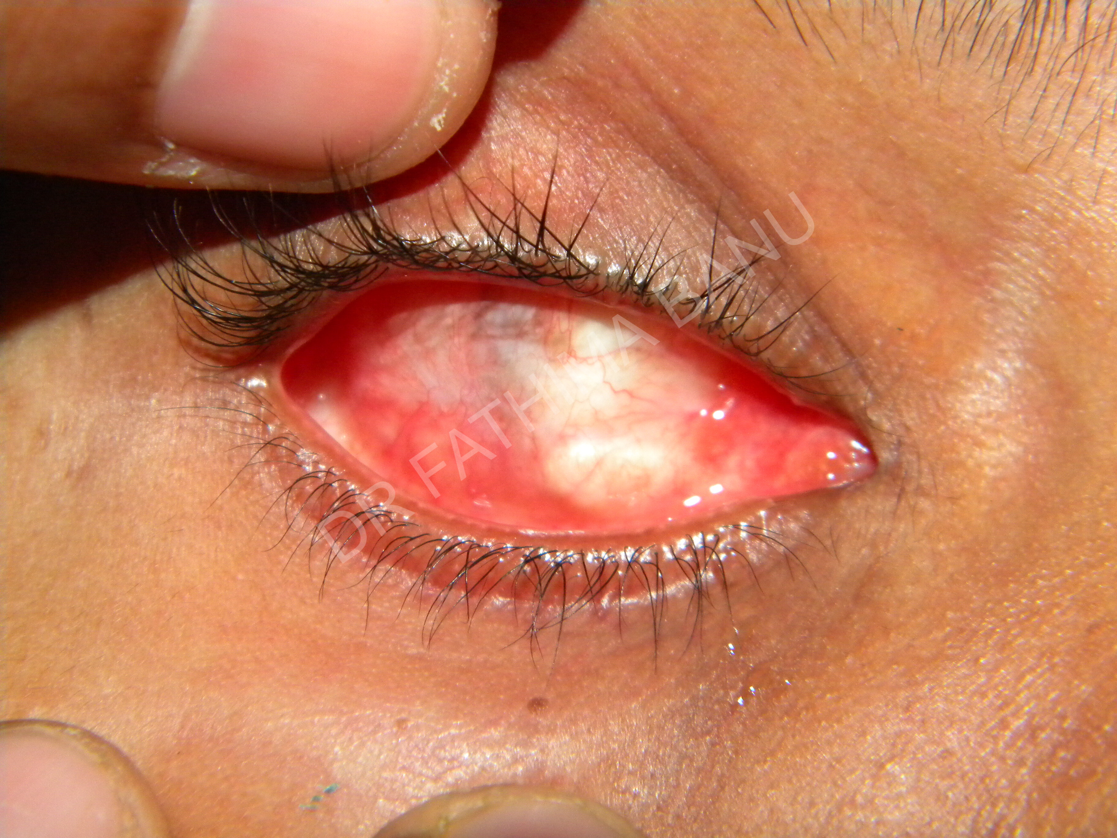 Eye prosthesis Before