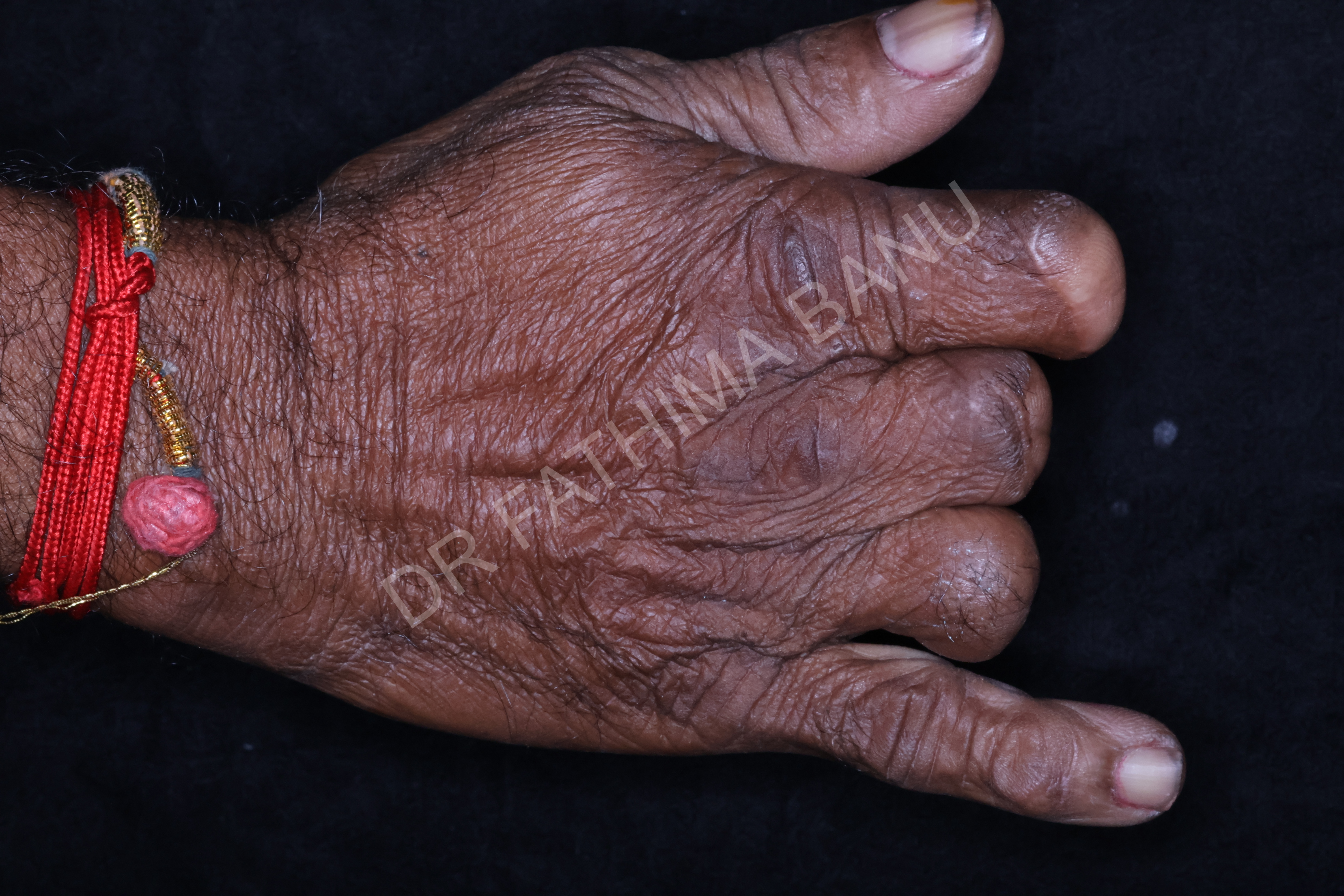 Finger prosthesis Before