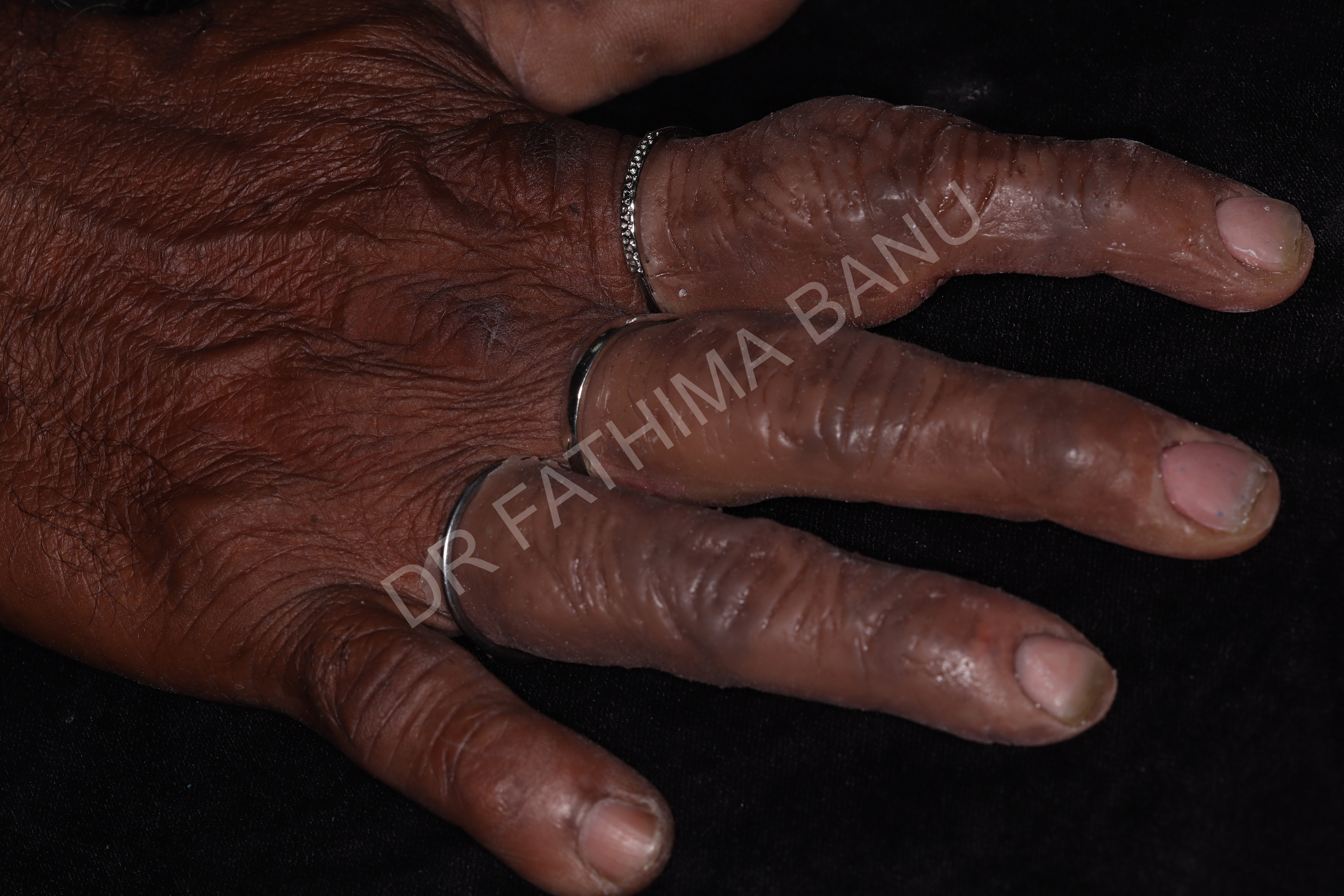 Finger prosthesis After