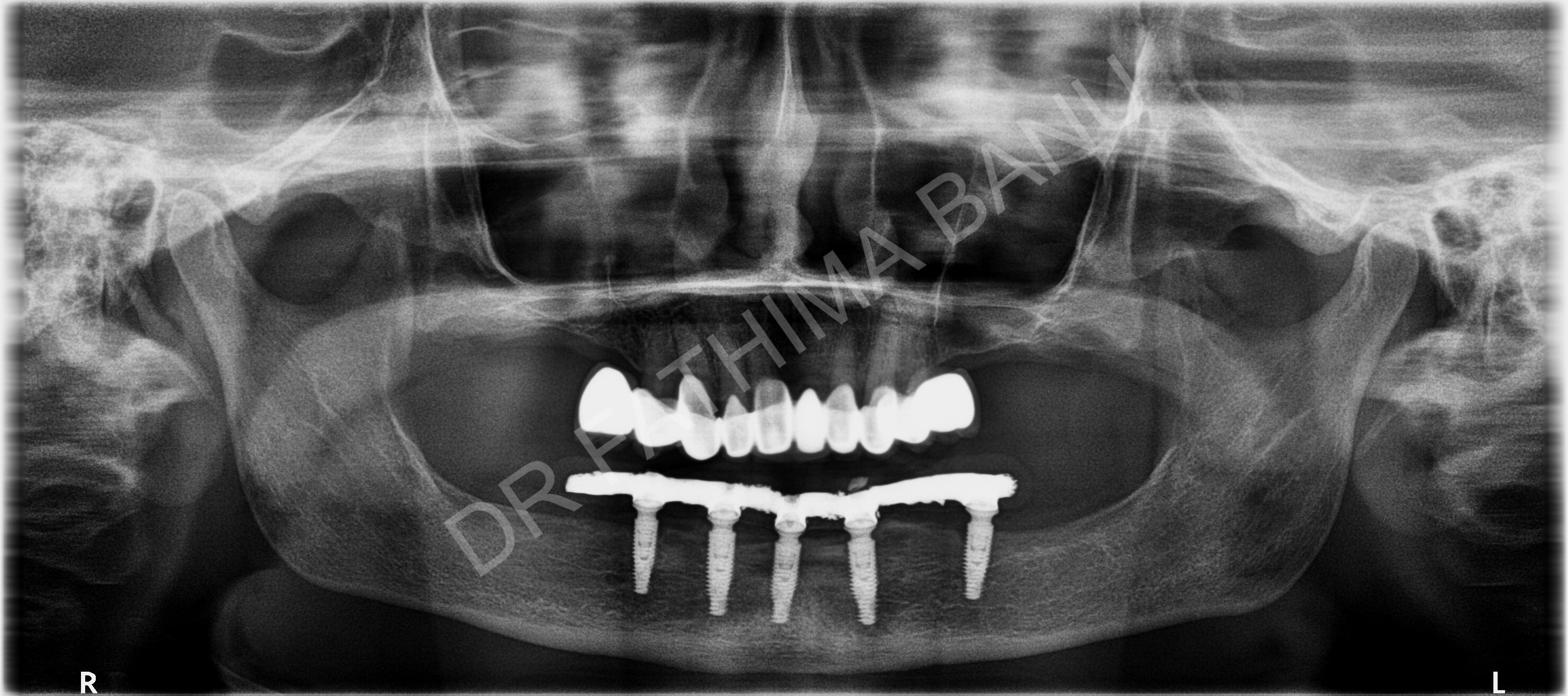 Dental Implant Case