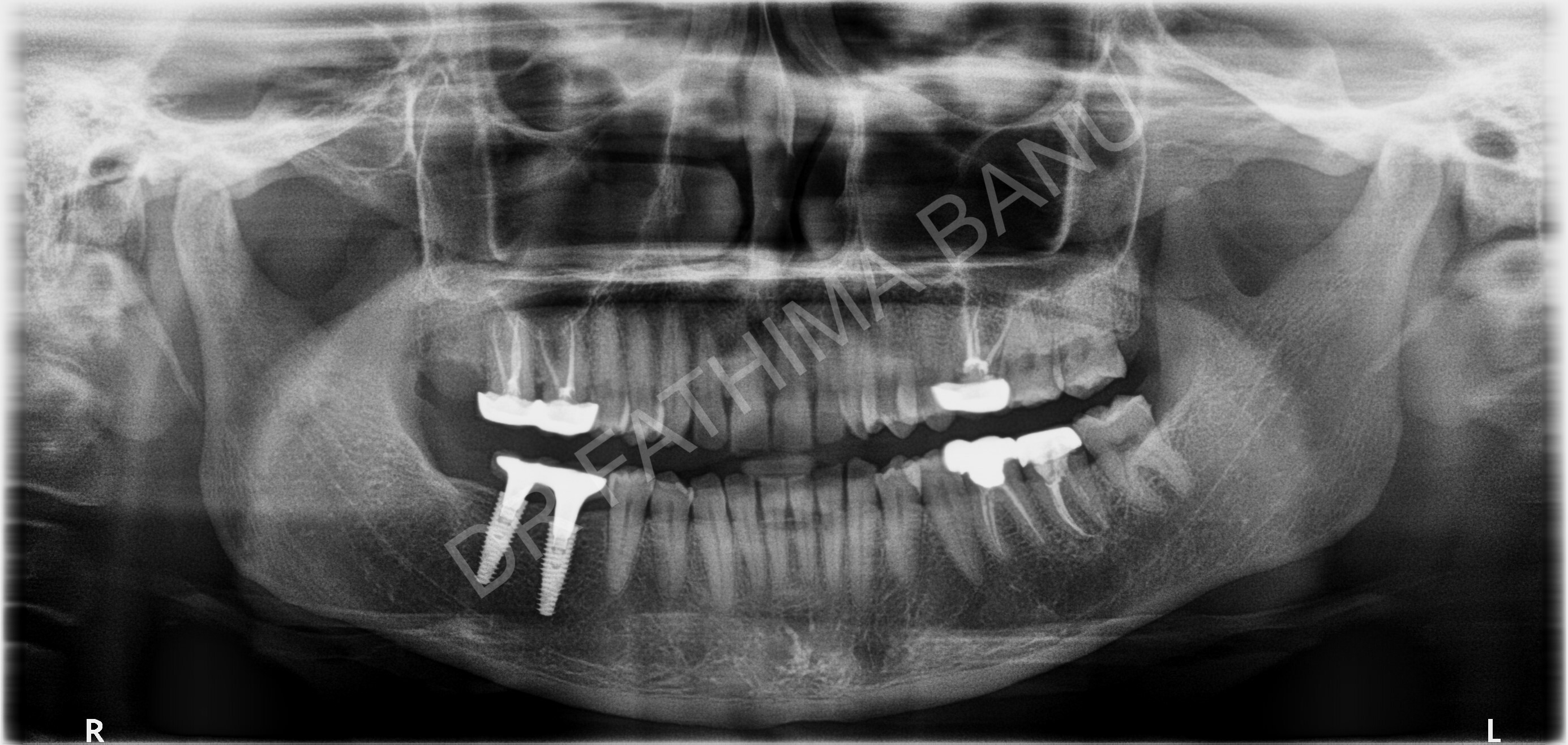 Dental Implant Case